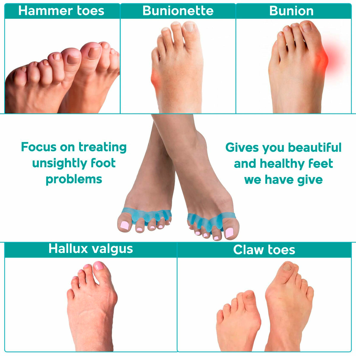 NAMELESS NICHE Toe Separators Bunion Corrector Toe Spacers White 1 Pair